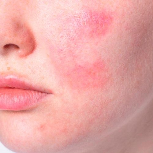 Rosacea